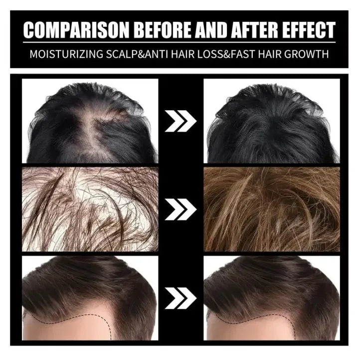 FORT Minoxidil Hair Growth Spray - Hair Tonic for Hair Care and Hair Growth - Premium Hair Care Product Women and Men all Hair Types